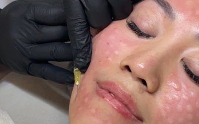 Skinbooster di Surabaya: Solusi Kulit Glowing, Kenyal, dan Lembap Tanpa Downtime